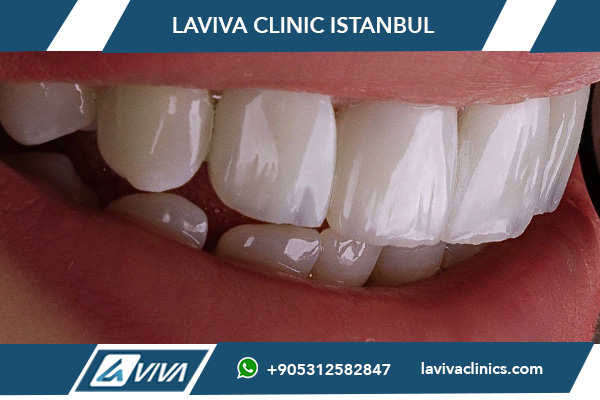 Fases de la implantación dental