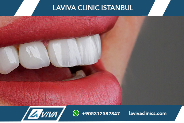 Виниры в Турции