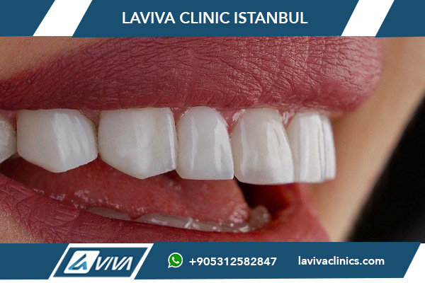 Innesto osseo dentale