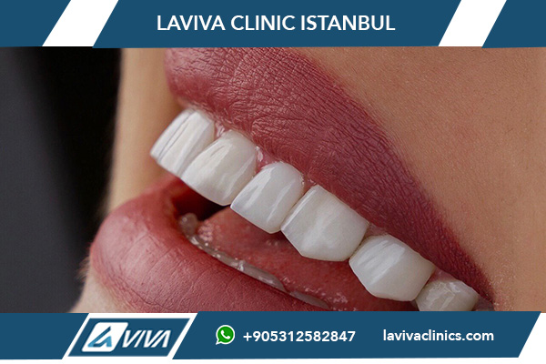 Как выбрать подходящий цвет виниров