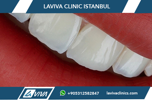 Голливудская улыбка