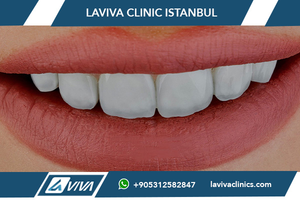 Уход за зубными винирами