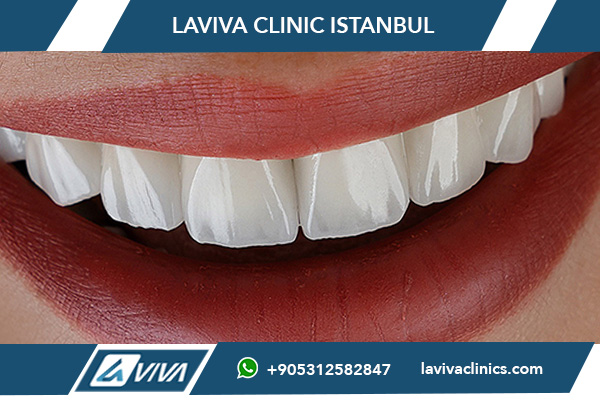 Faccette Dentali in Turchia